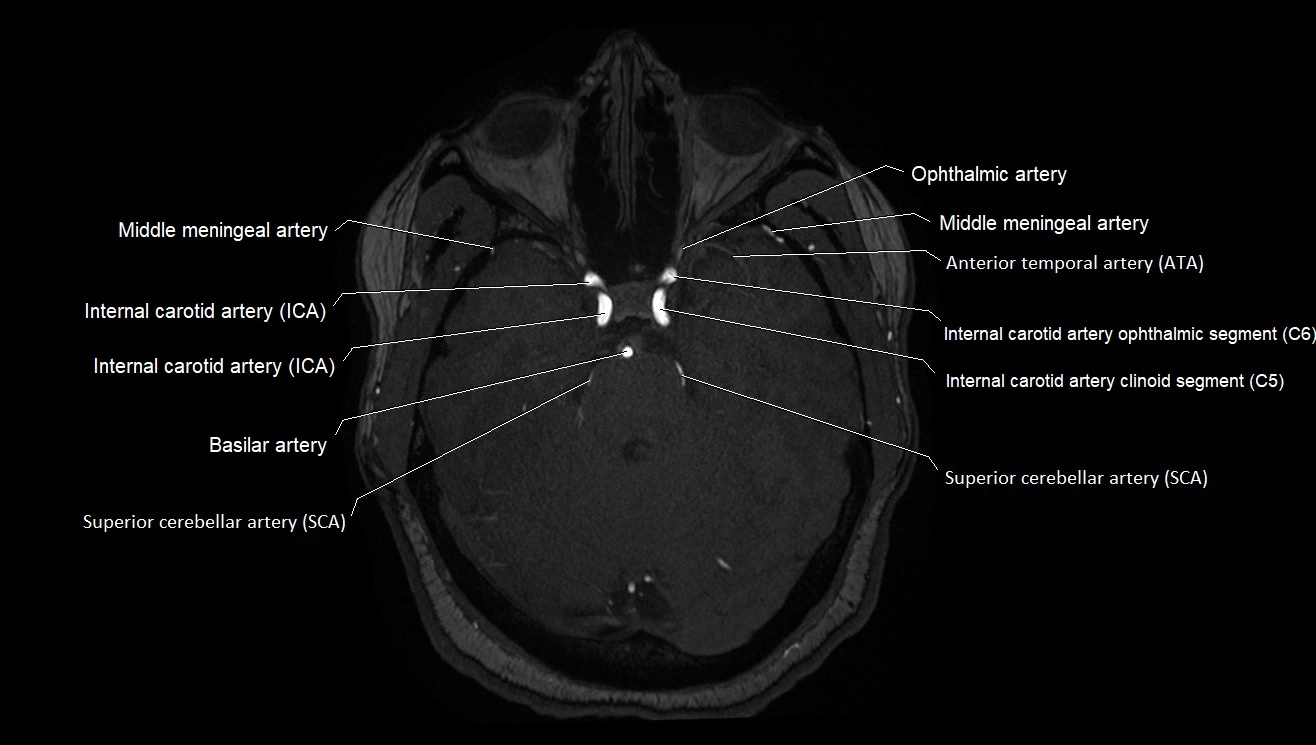 MRA brain (cerebral arteries) anatomy axial 3T image 10.webp